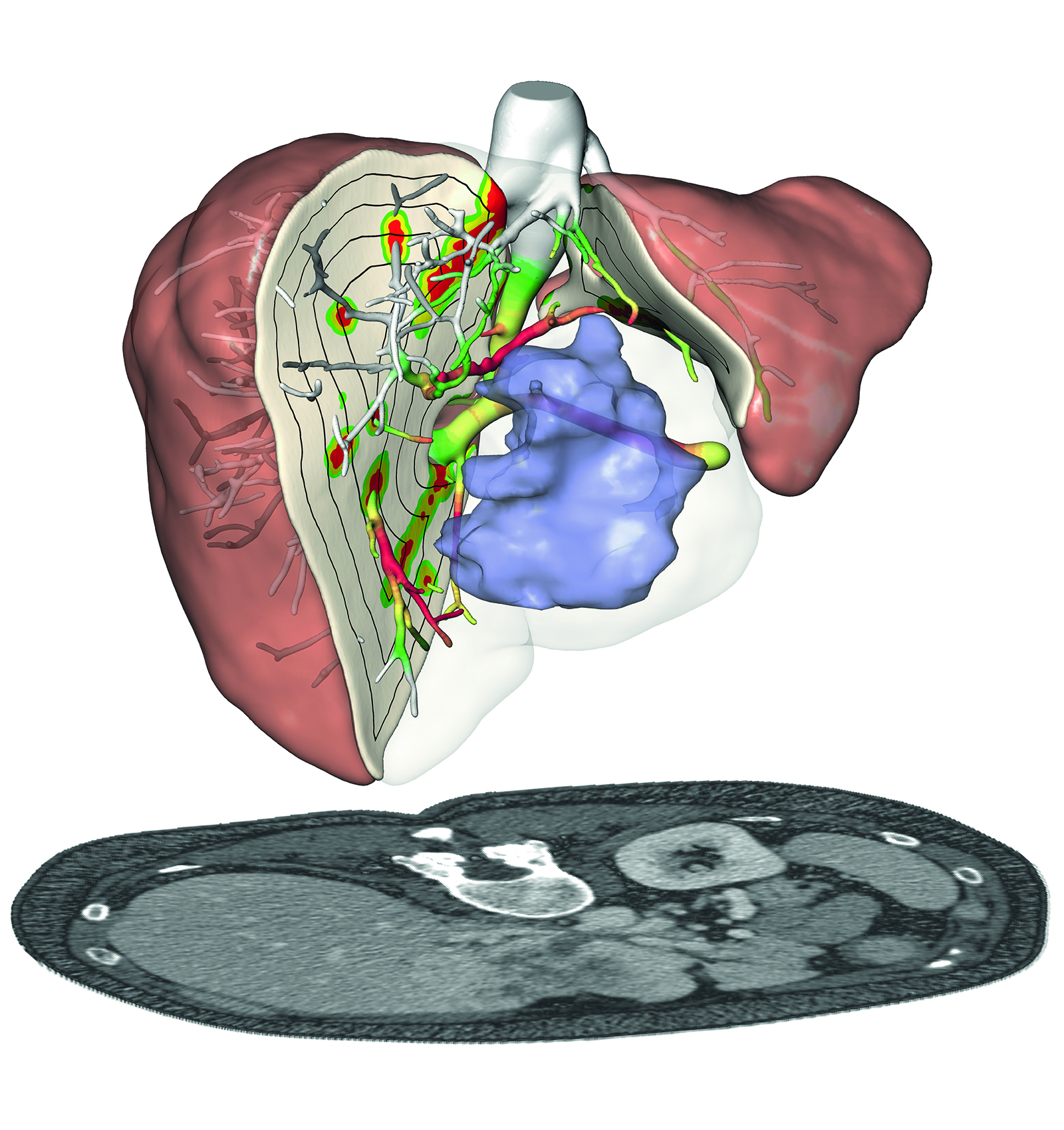 Planung und Risikoanalyse für die chirurgische Entfernung eines zentral gelegenen Lebertumors.