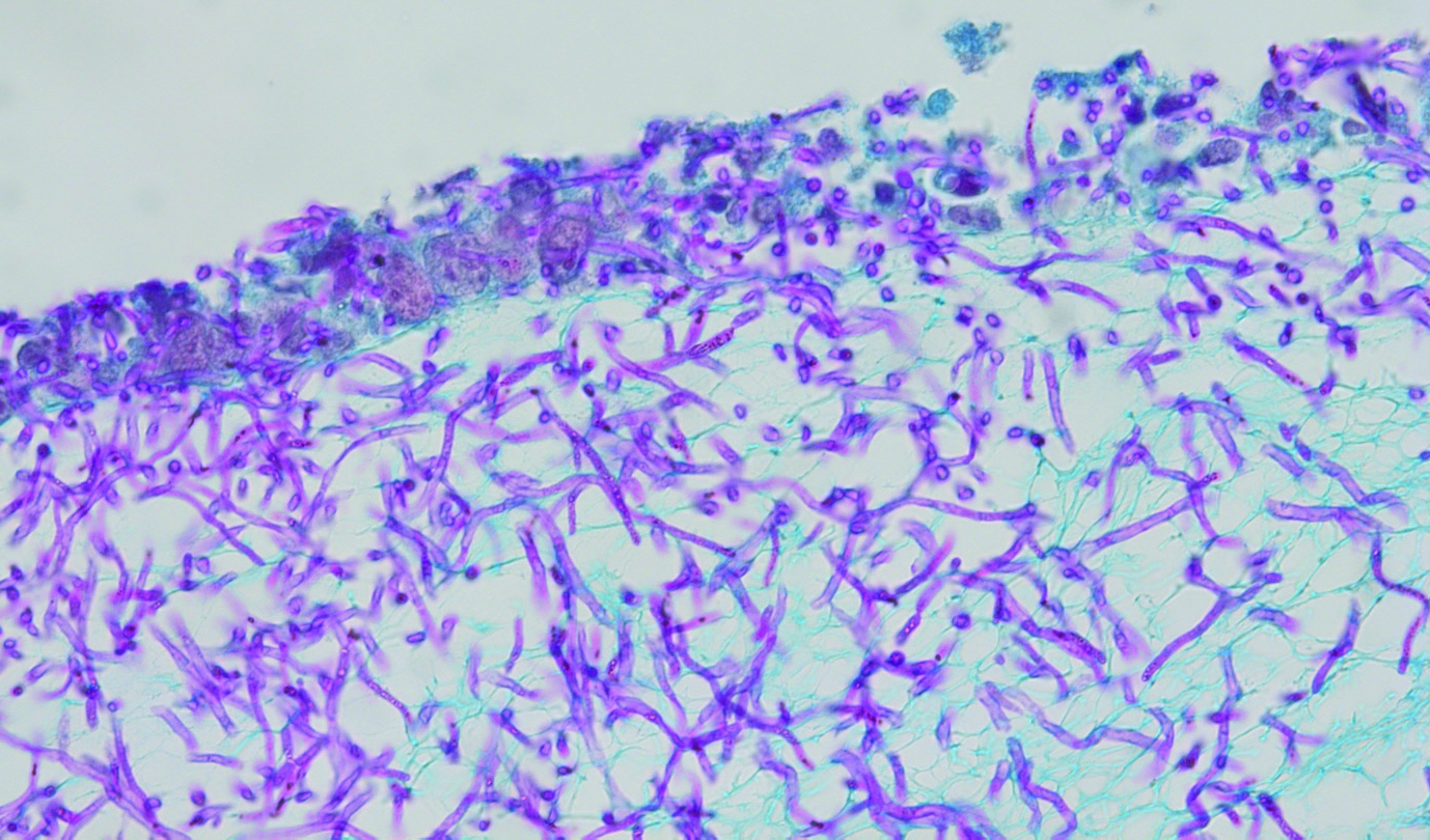 Epithel-Infektionsmodell: Gefärbtes Gewebe nach einer Invasion von Candida albicans (violett) in menschliche Epithelzellen (blau).