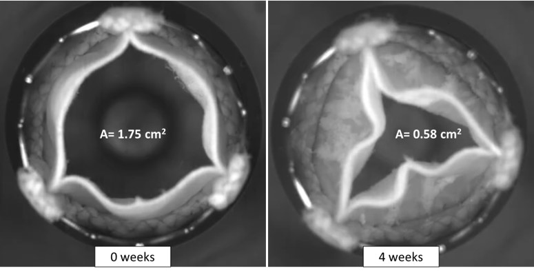 Verkalkung beeinträchtigt die Herzklappenfunktion (rechts). Dies ist das Ergebnis eines In-vitro-Kalzifizierungstests.