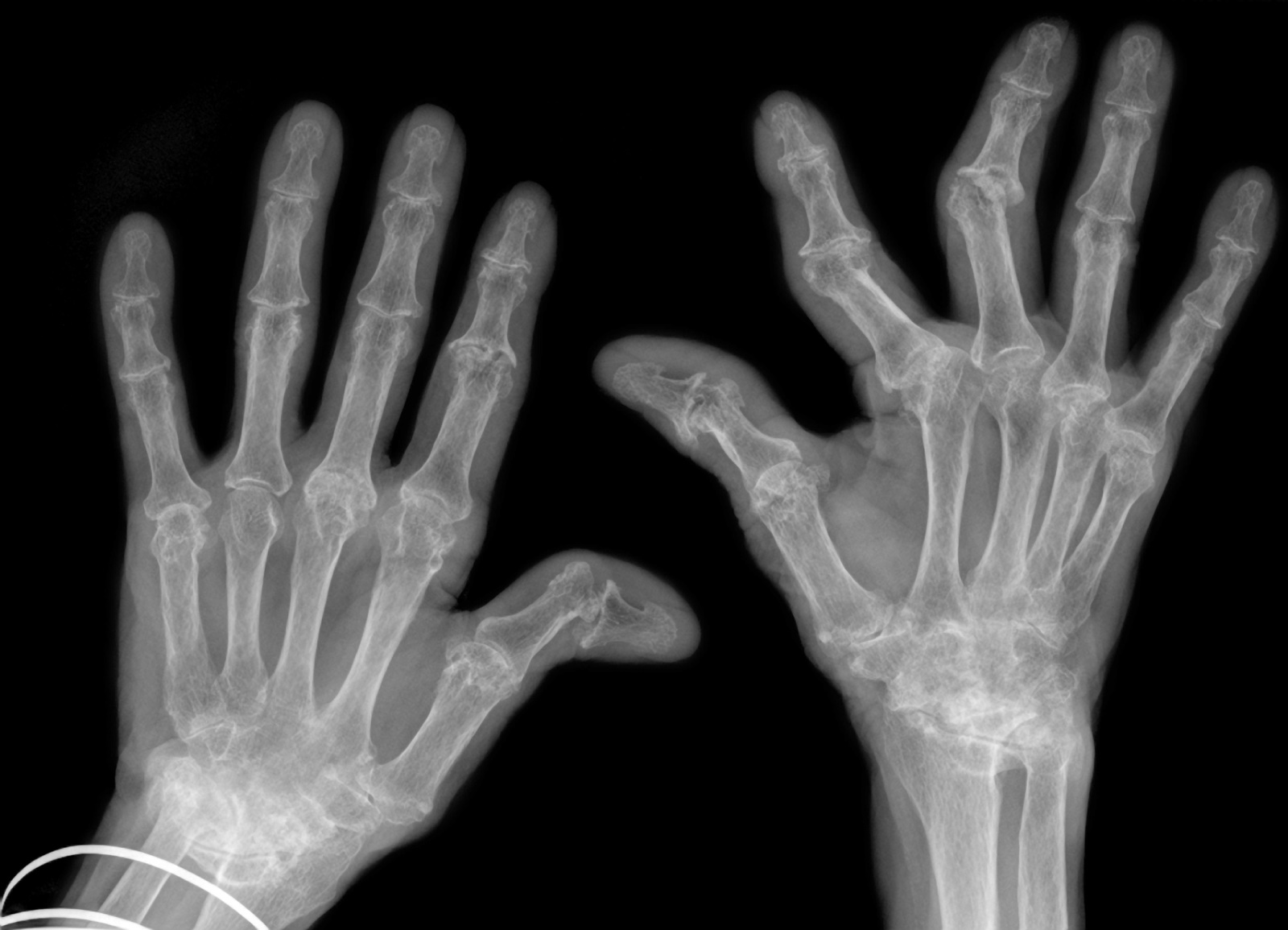 Volkskrankheit rheumatoide Arthritis: Auch stark gekrümmte Finger können mit einem FingerKIt-Implantat optimal behandelt werden.