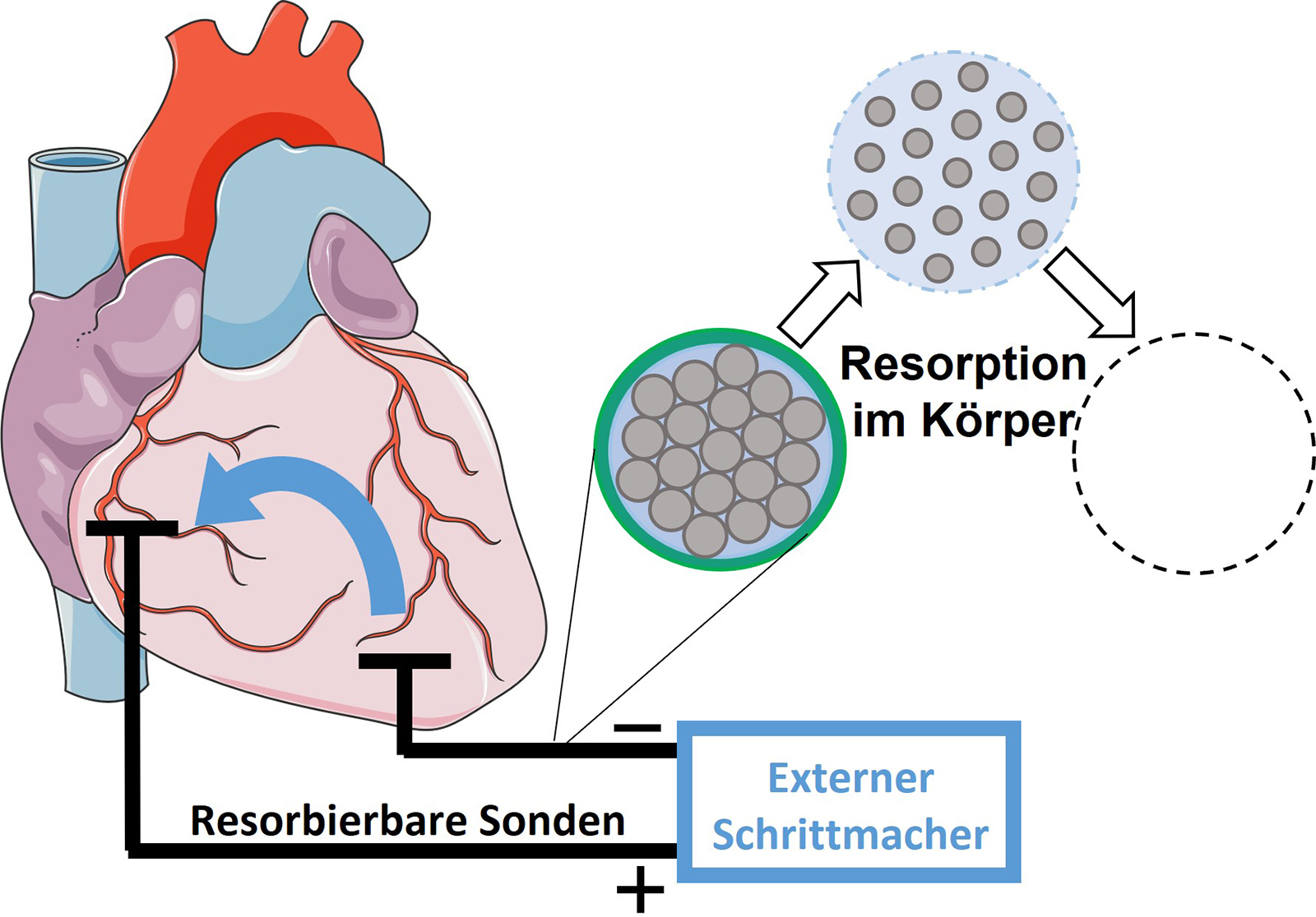 Im Anschluss an die postoperative Überwachungsperiode von wenigen Tagen können die resorbierbaren Schrittmachersonden im Körper verbleiben und werden langsam abgebaut.