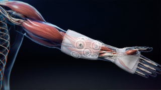 Eine koordinierte Stimulation der Mikroimplantate unterstützt bei der Ausführung von Handbewegungen.