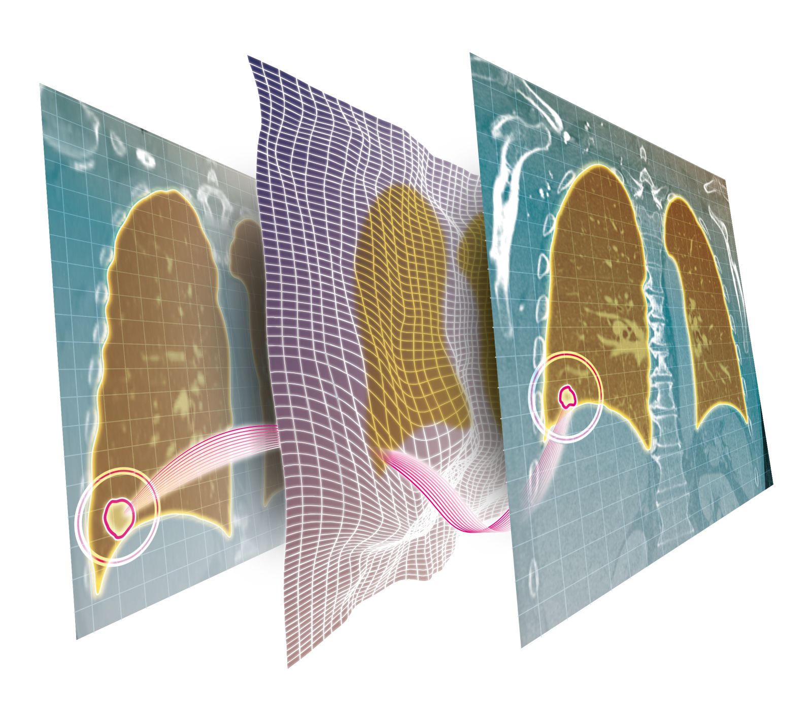 Dank eines Deep-Learning-Ansatzes lassen sich CT-Bilder in der Krebstherapie automatisch abgleichen – und selbst kleine Veränderungen von Lungentumoren noch schneller und präziser verorten. 