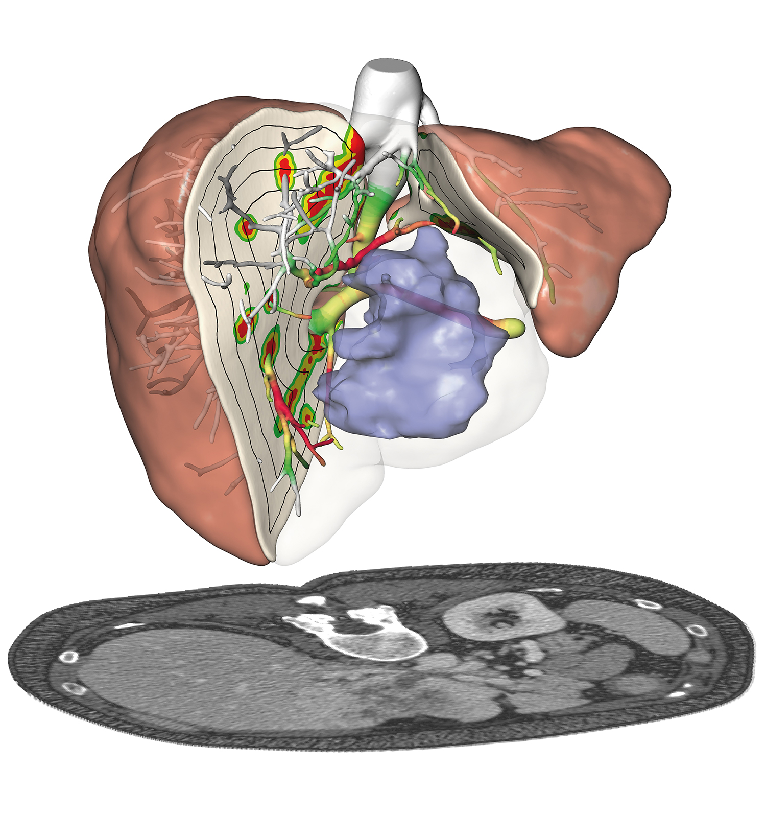 Planung und Risikoanalyse für die chirurgische Entfernung eines zentral gelegenen Lebertumors.