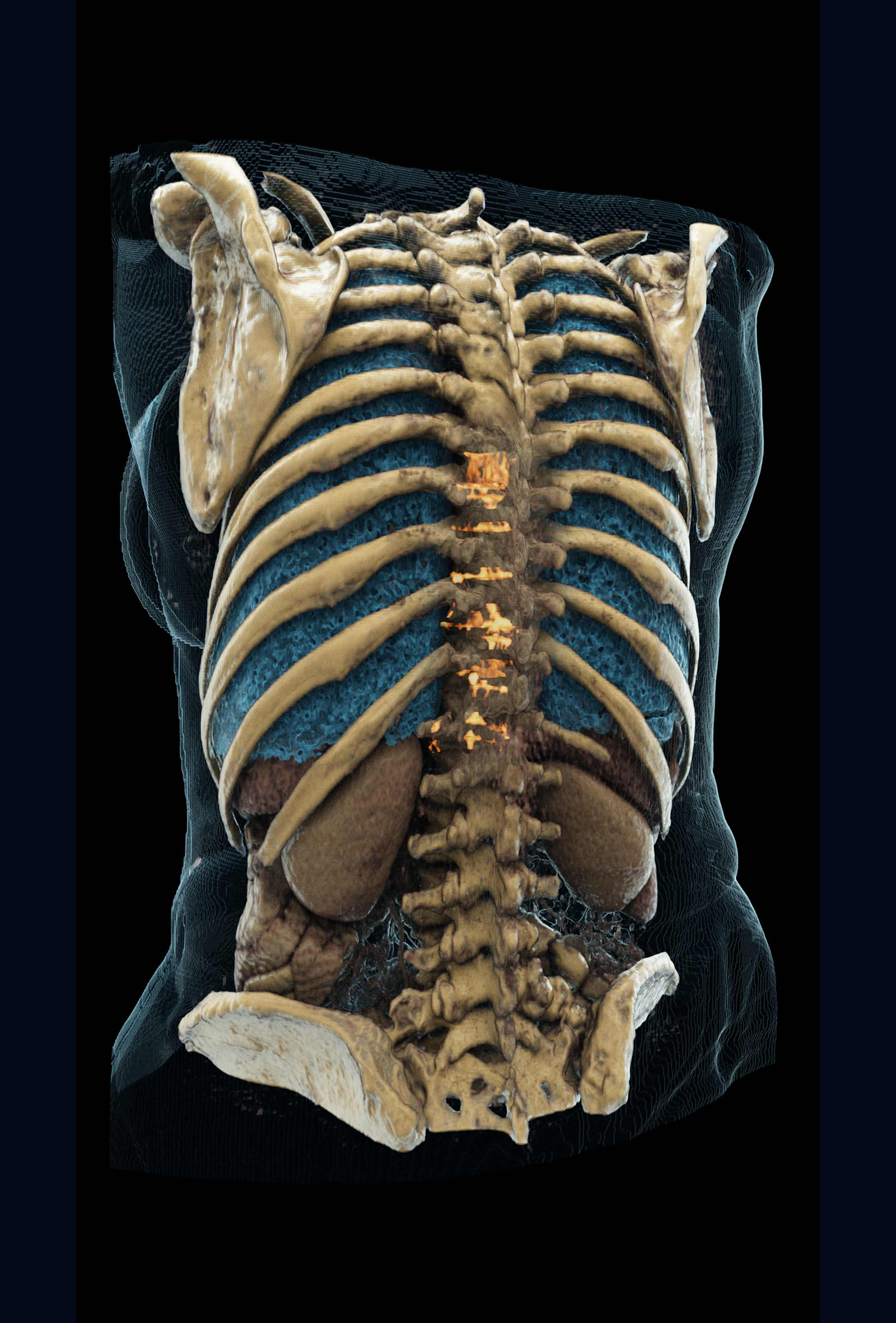 3D Visualization of a patient CT image with highlighted metastases of the spine. Deep learning methods help discover bone metastases, which can be overlooked in clinical routine. CT dataset courtesy of Radboudumc, Nijmegen, NL. 