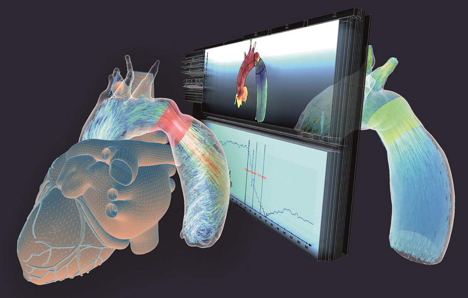 Simulation of the changes in blood flow after a virtual stent placement in a narrowing in the aorta. The comparison of the outcome of different treatments enables the selection of the most promising strategy. 