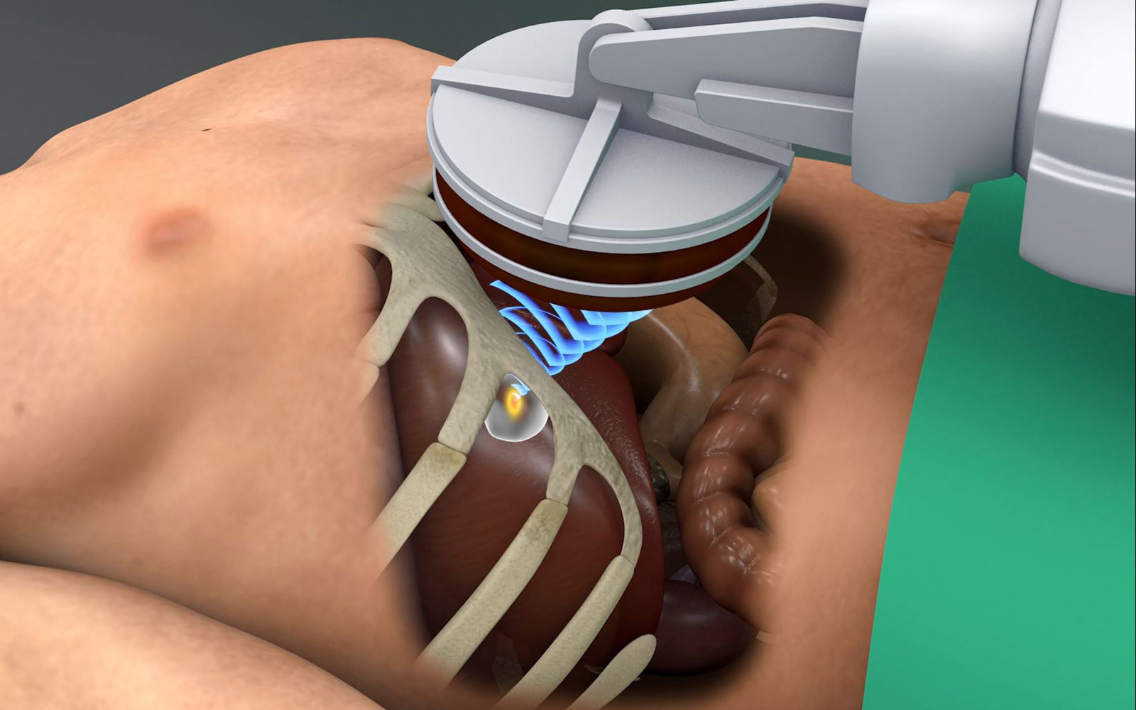 Doctors wish to use focused ultrasound to treat tumors in moving organs, such as the liver, shown here.