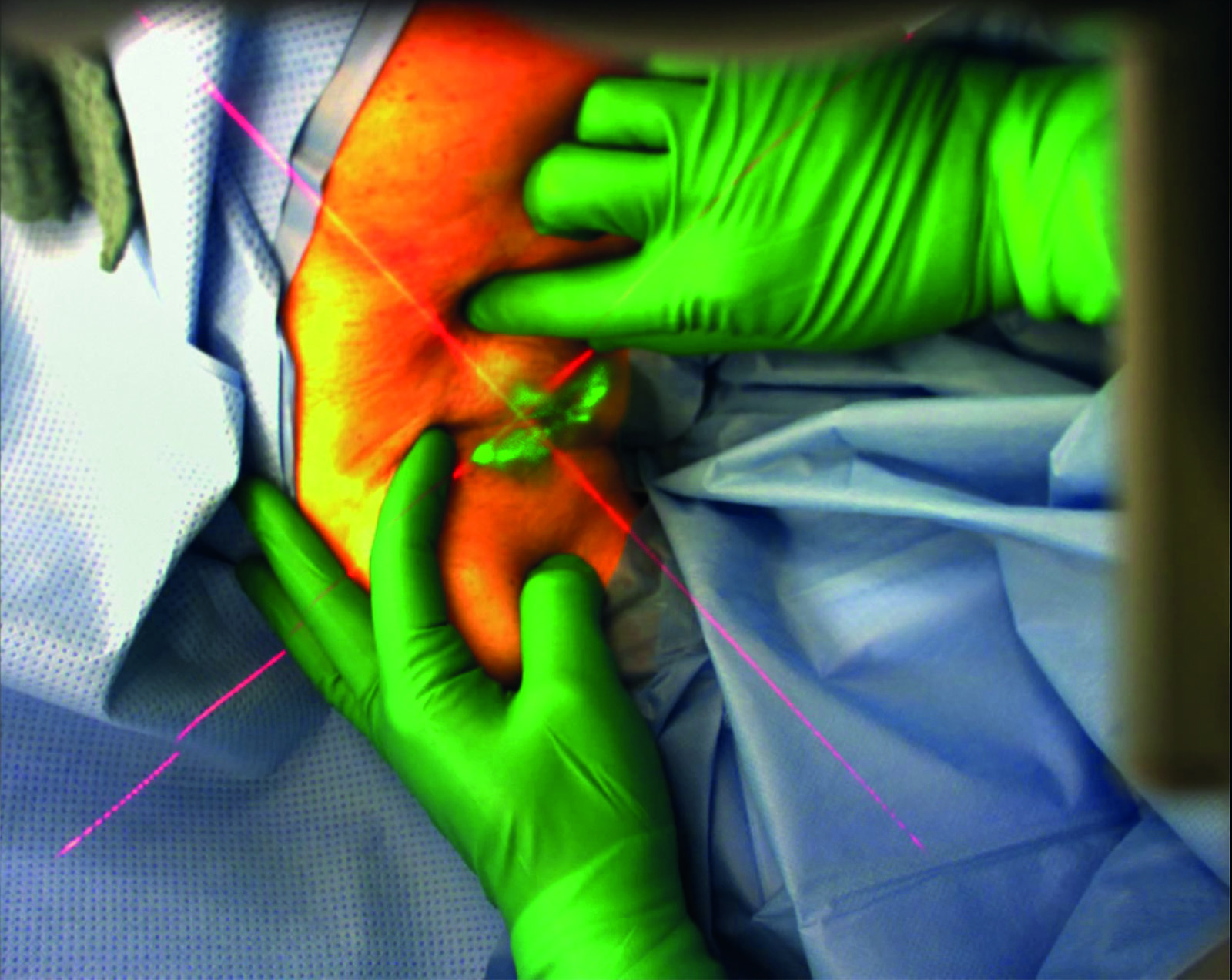 AR glasses enable the doctor to precisely locate the site of the lymph node during surgery. 