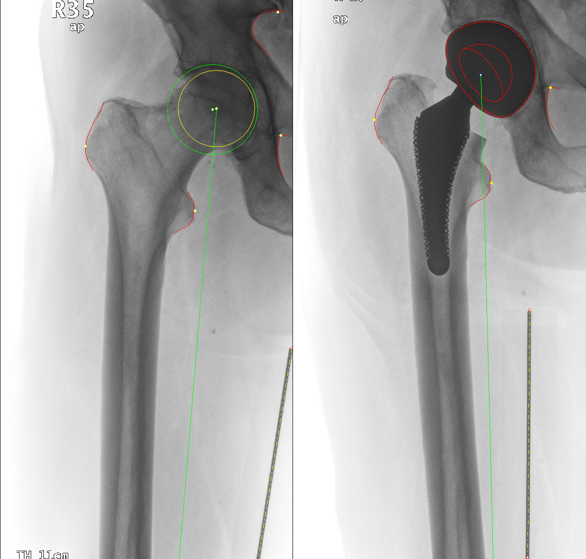 The pre-op planning software enables the surgeon to select the ideal implant and define its position.