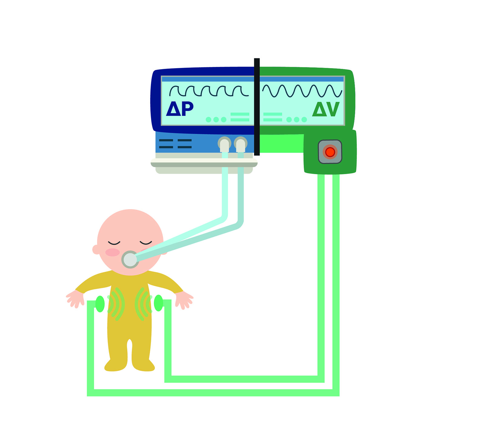 A visualization of the Thorax Monitoring system in action: The system continually monitors the premature infant’s breathing. The aim is to use the data combined with measurements from the ventilator to administer artificial respiration more efficiently, and in a way that protects the patient.