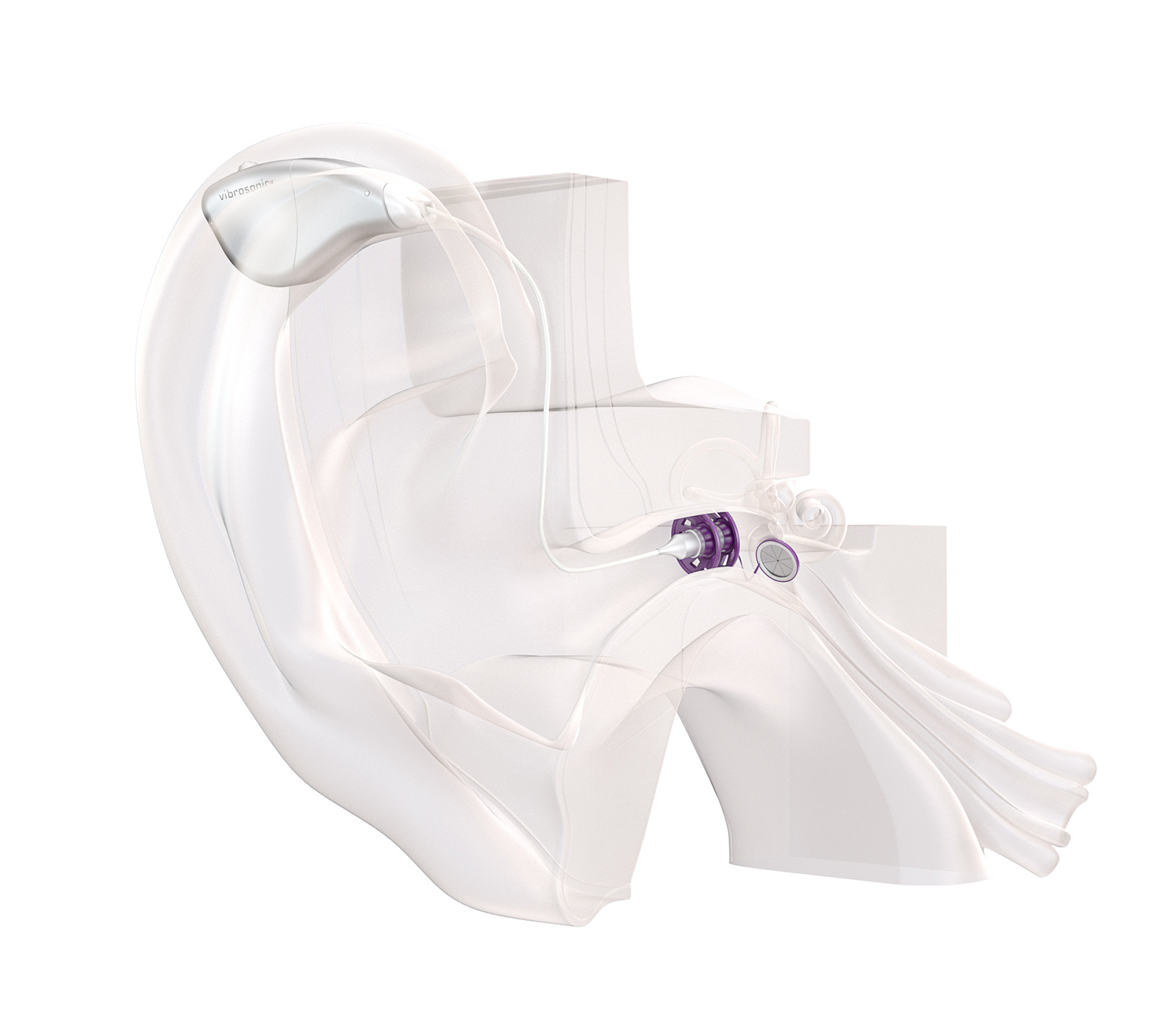 The hearing contact lens® and the auditory canal module are connected to a sound processor that is worn behind the ear