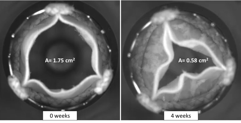 Calcification impairs heart valve function (right). This is the result of an in-vitro calcification test.