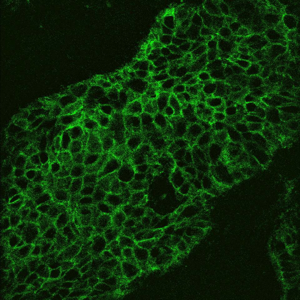 This fluorescent image shows a tumor section recorded with the LSC-Onco microscope. The fluorescent green area indicates cancer cells.