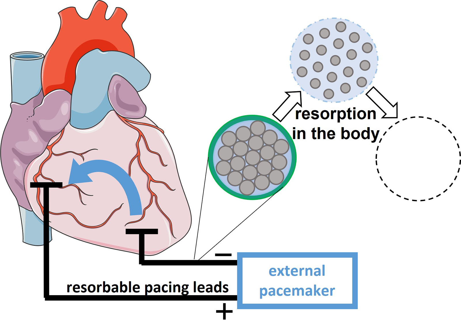 After the postoperative monitoring period, which lasts a few days, the resorbable pacing leads can remain in the body, where they slowly degrade.