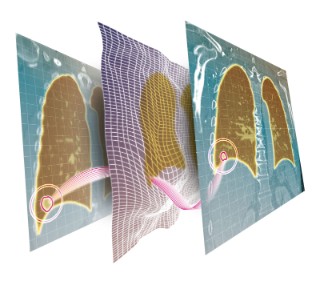 Dank eines Deep-Learning-Ansatzes lassen sich CT-Bilder in der Krebstherapie automatisch abgleichen – und selbst kleine Veränderungen von Lungentumoren noch schneller und präziser verorten. 