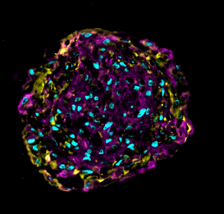 Miniherz: Ein funktionelles, eigenständig schlagendes Organoid, das aus Herzmuskelzellen (Kardiomyozyten, in Pink), kardialen Fibroblasten (Bindegewebszellen, in Gelb) und Endothelzellen (Gefäßzellen) besteht (Zellkerne in Blau).