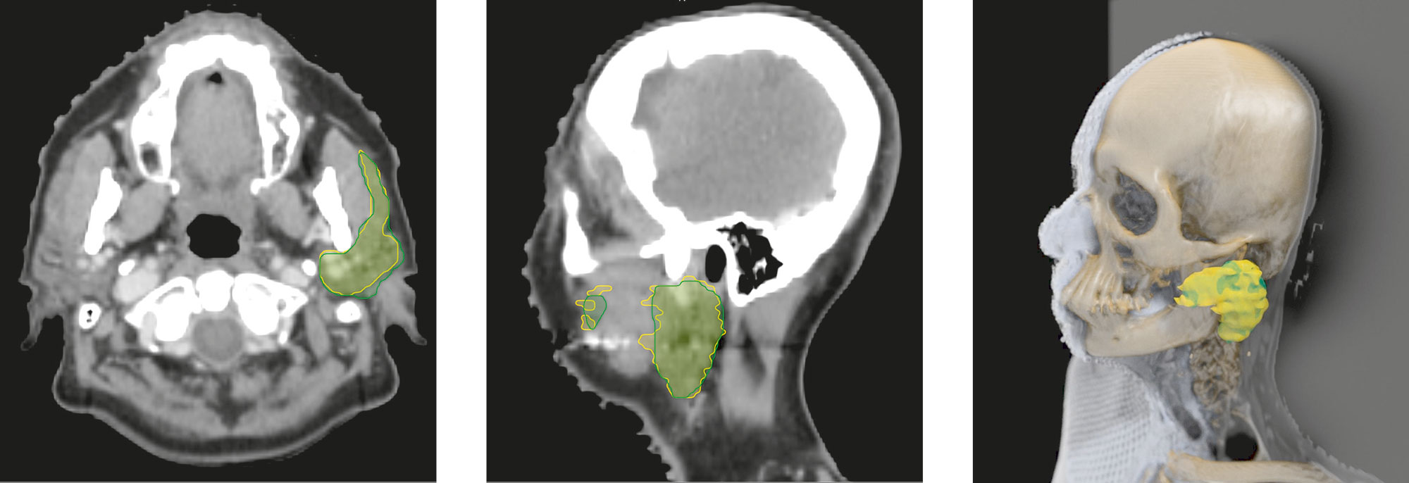 Two lines surround the parotid gland on the CT scan. A doctor drew the yellow line; a learning algorithm computed the green one. 