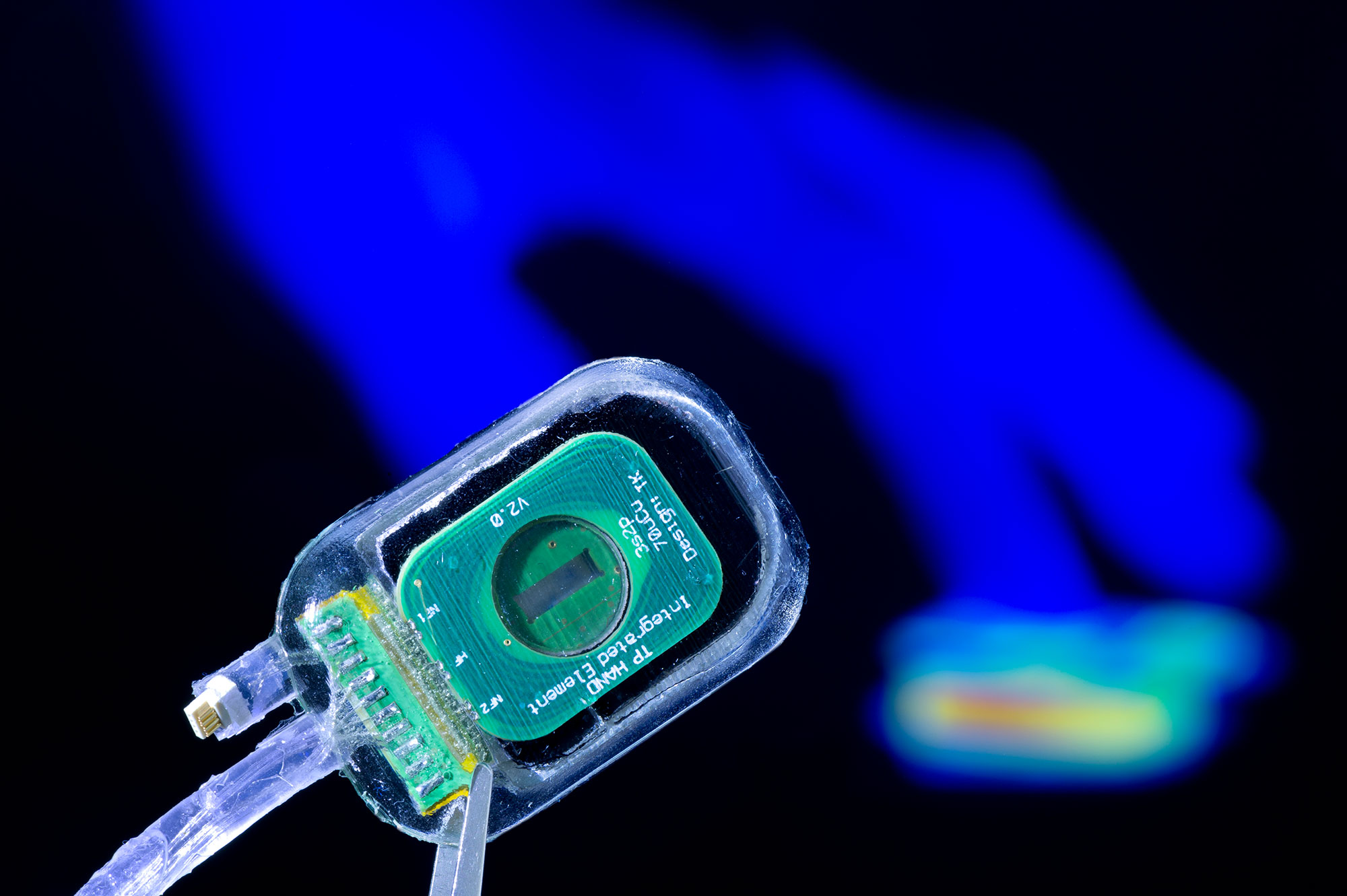 The control unit for the hand prosthesis (pictured at the top) is implanted in the forearm. The prosthesis delivers sensory feedback to the patient via a gossamer filament electrode that attaches to a nerve. Both pictures.